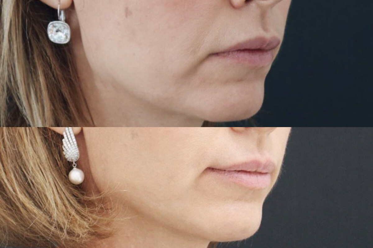 Ulthera System Альтера-терапия 01