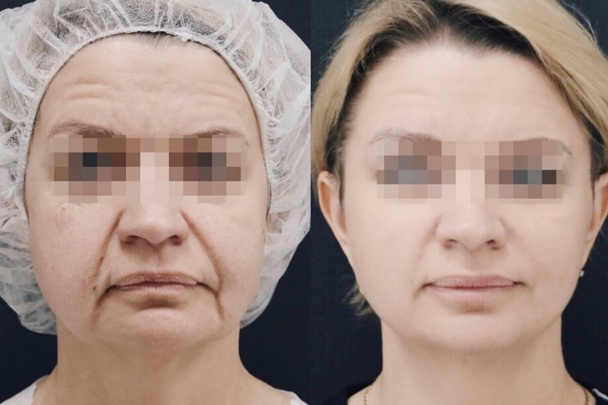 Ulthera System Альтера-терапия 01