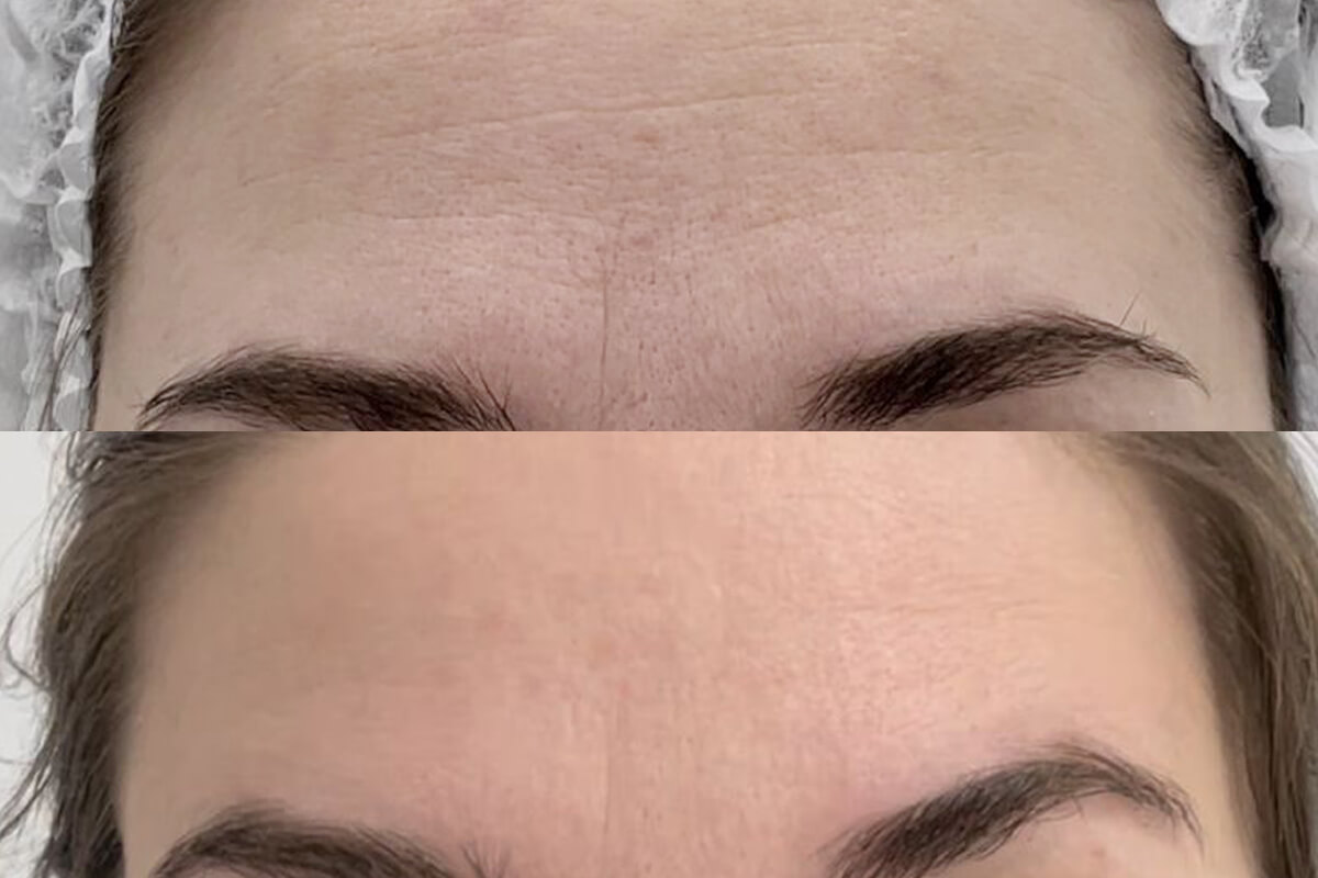 Ботулинотерапия 01