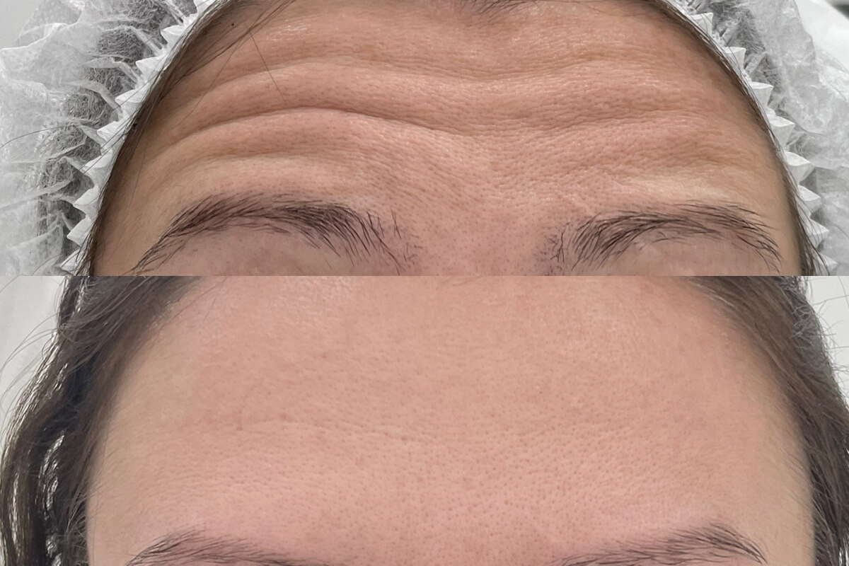 Ботулинотерапия 01