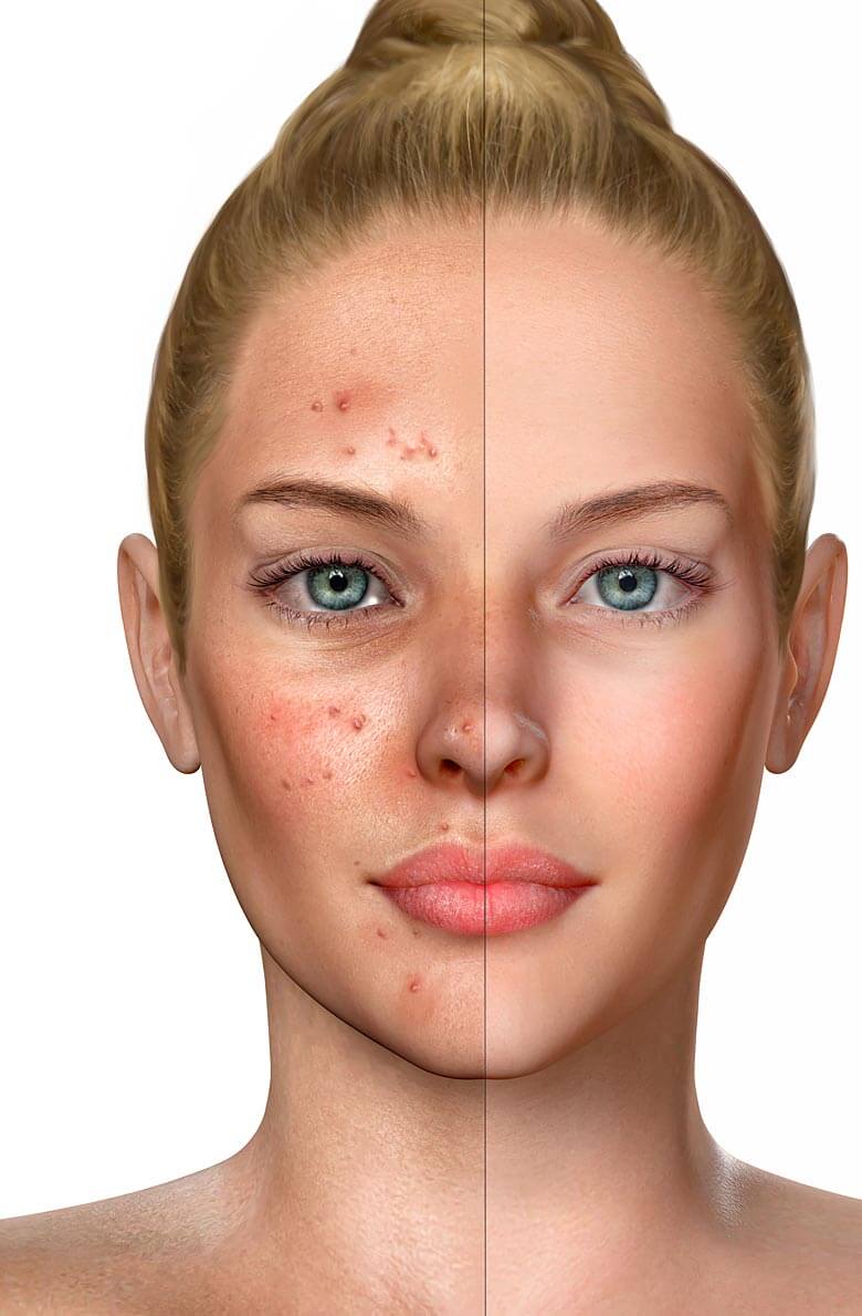 glubokaya-chistka-litsa-2