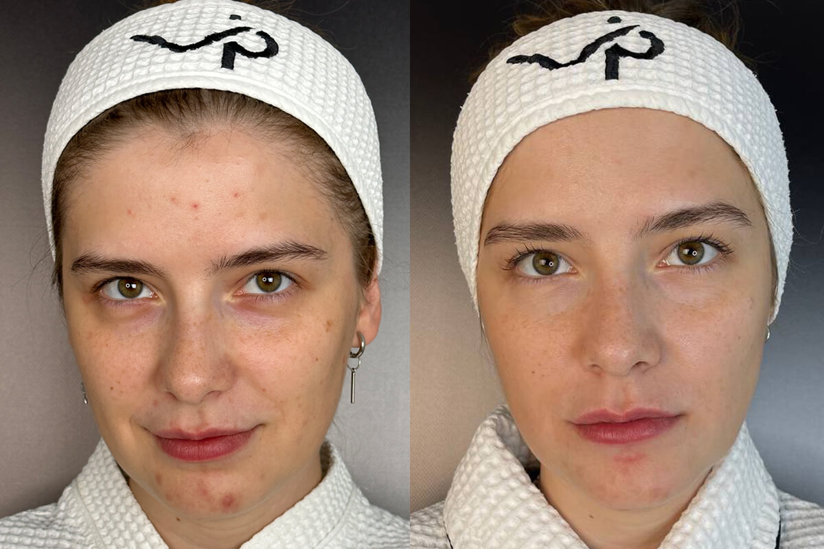 Фотодинамическая терапия Heleo-4 01