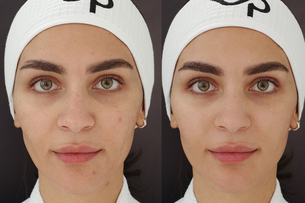 Фотодинамическая терапия Heleo-4 01