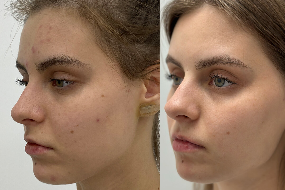 Фотодинамическая терапия Heleo-4 01