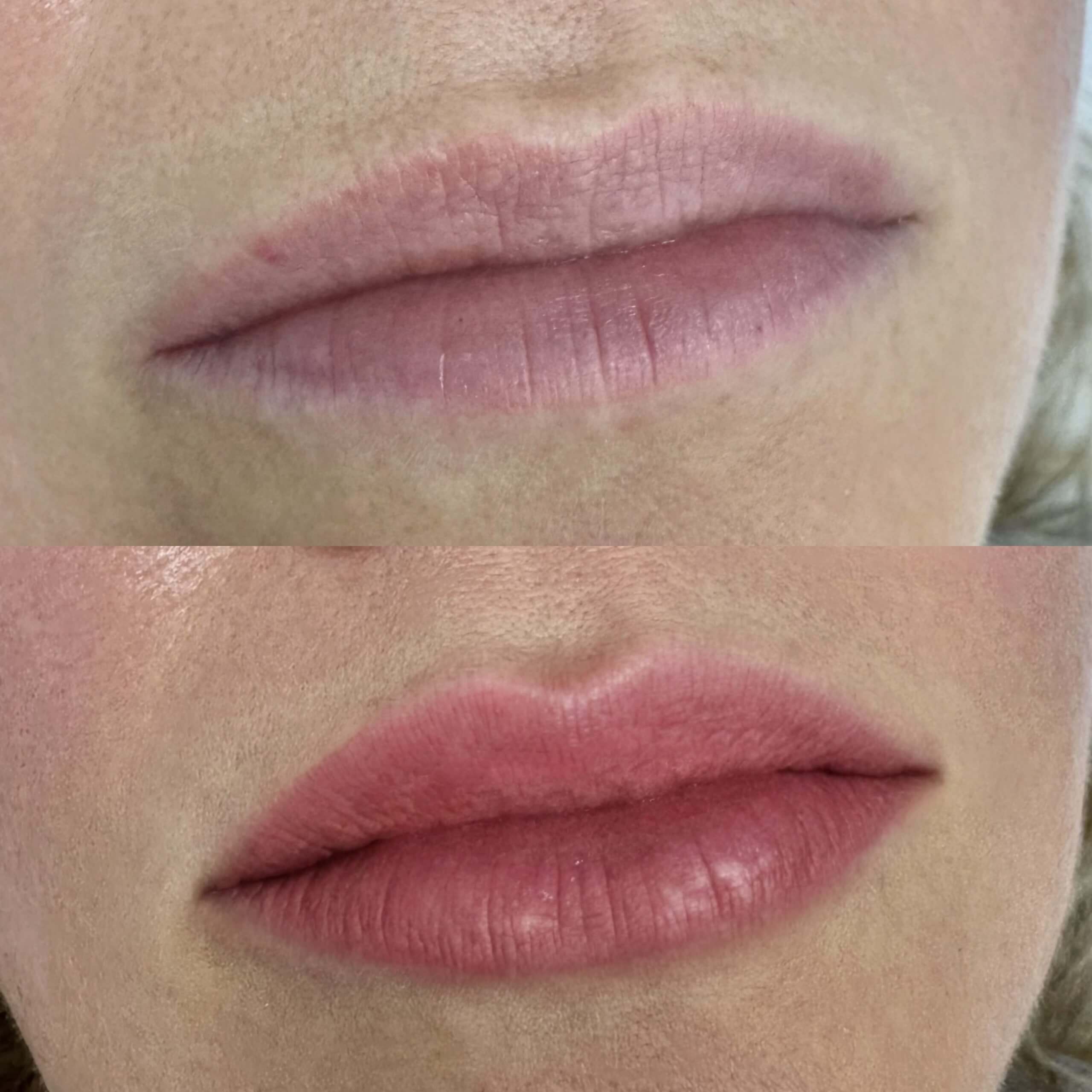 Увеличение губ 01