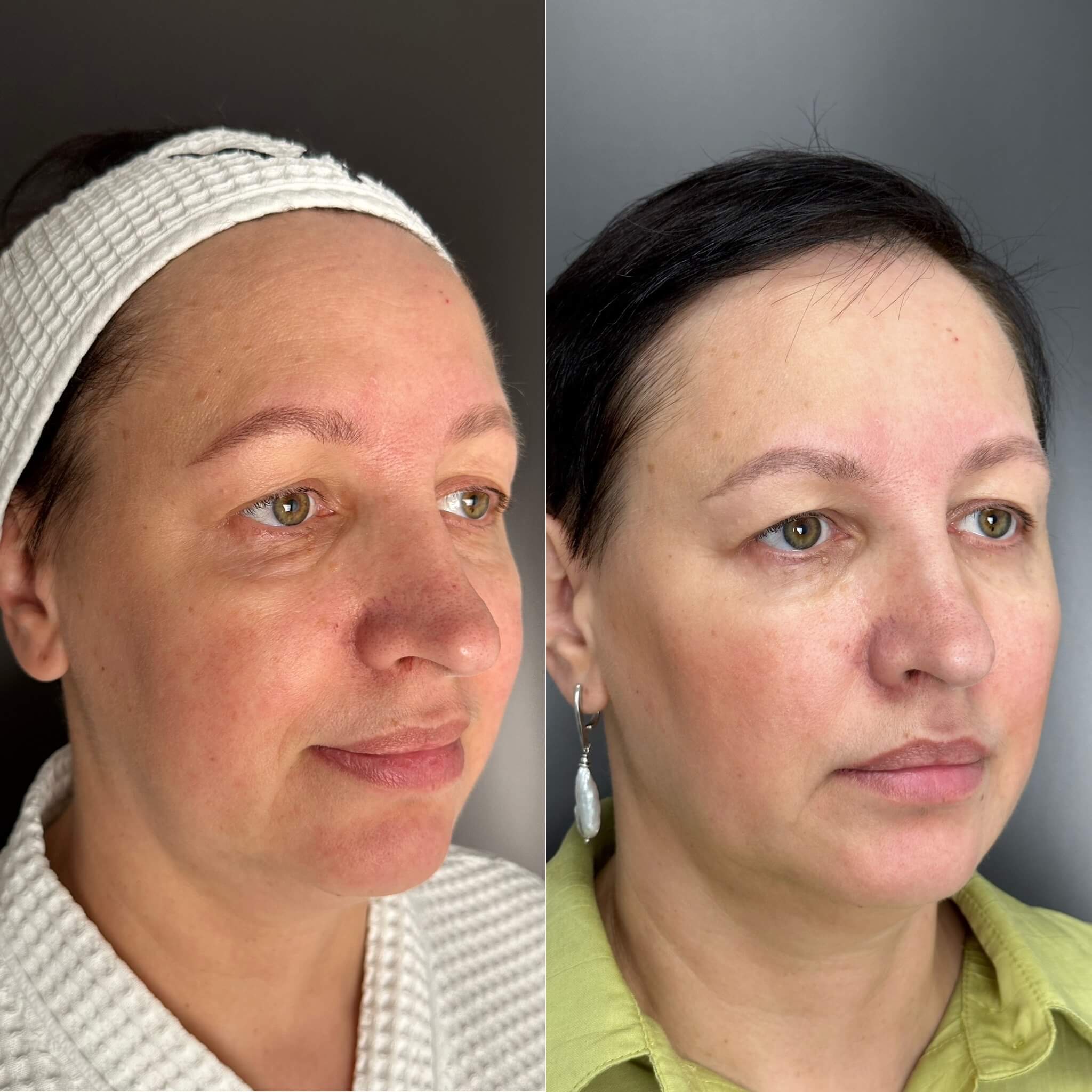 Контурная пластика лица 01