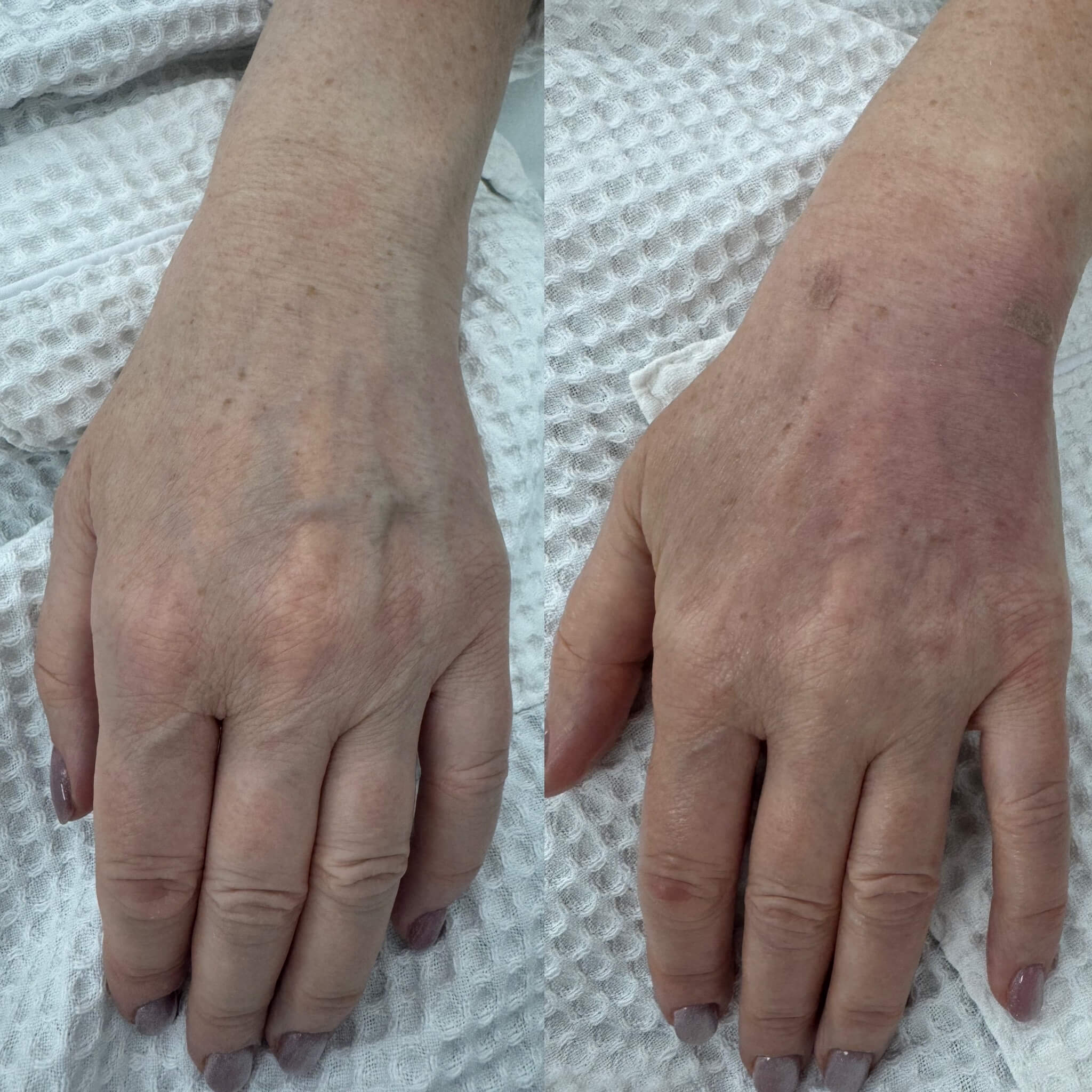 Контурная пластика лица 01