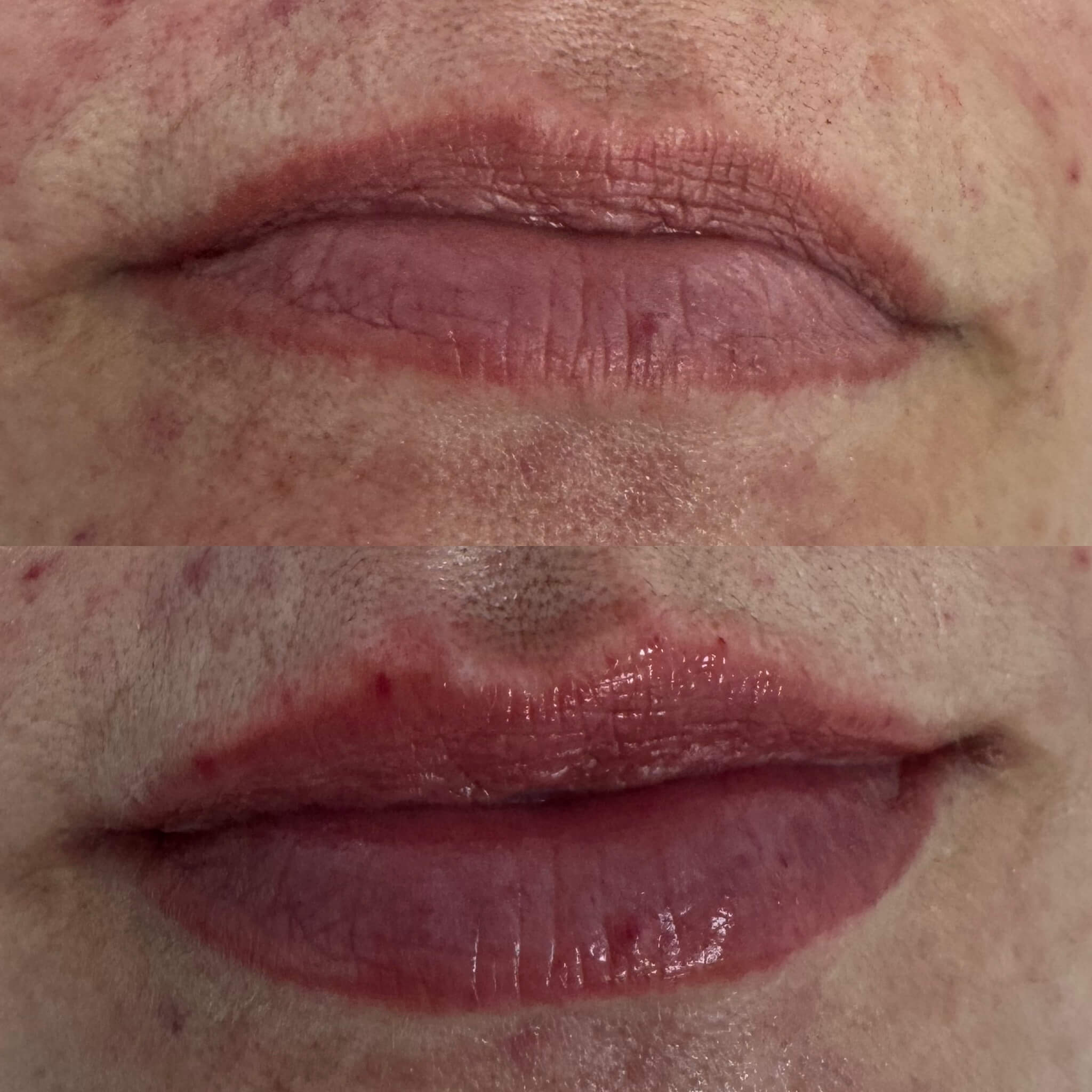 Увеличение губ 01