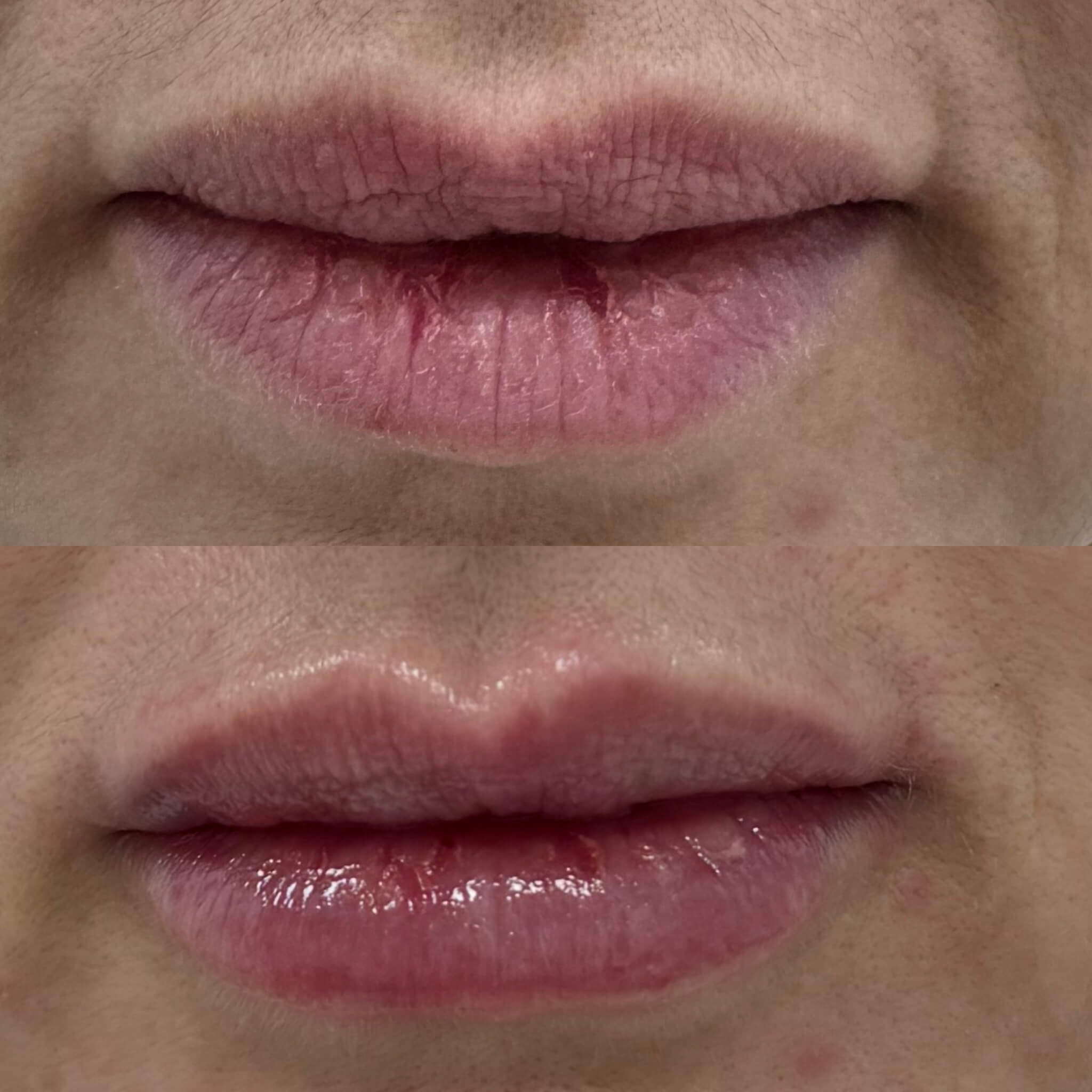 Увеличение губ 01