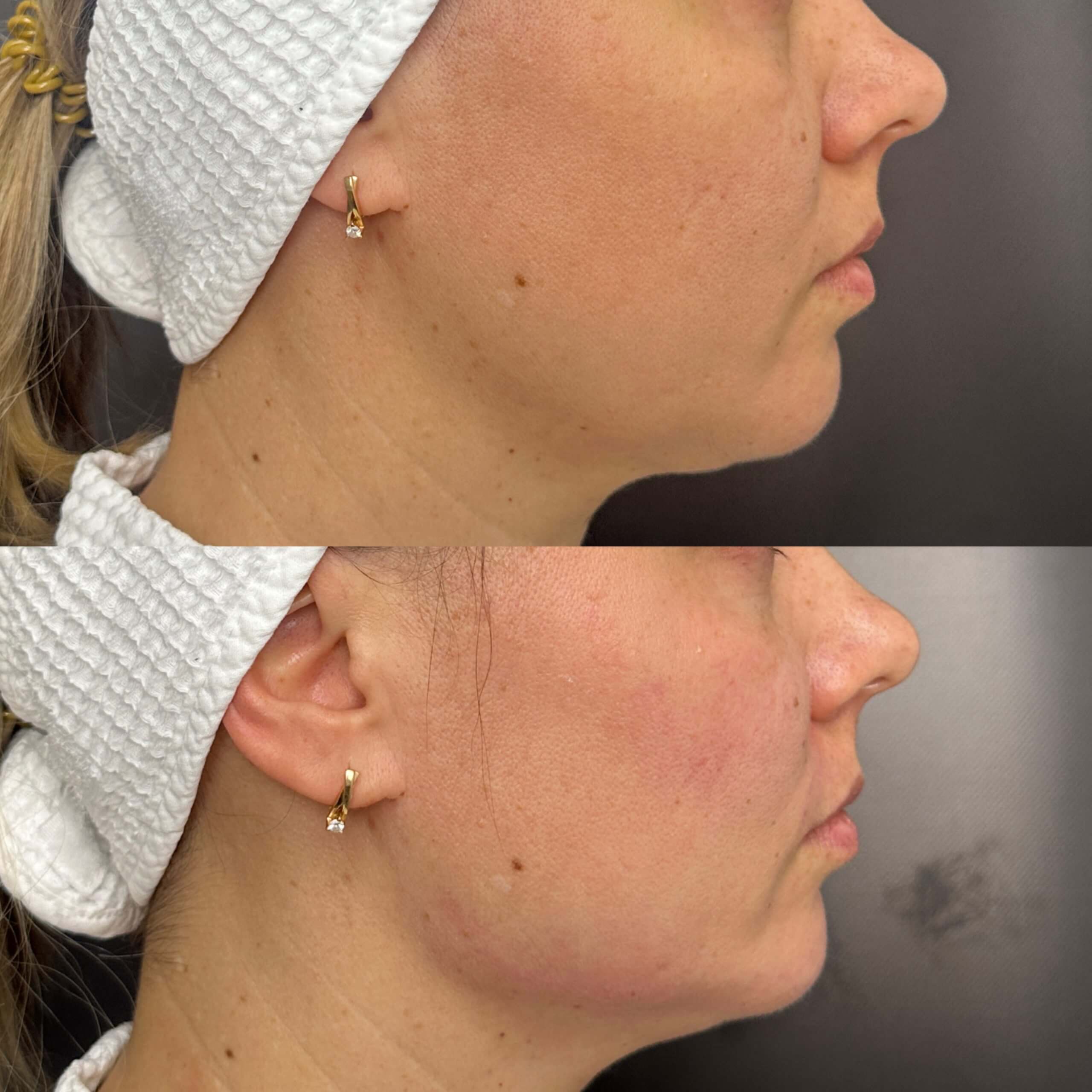 Контурная пластика лица 01