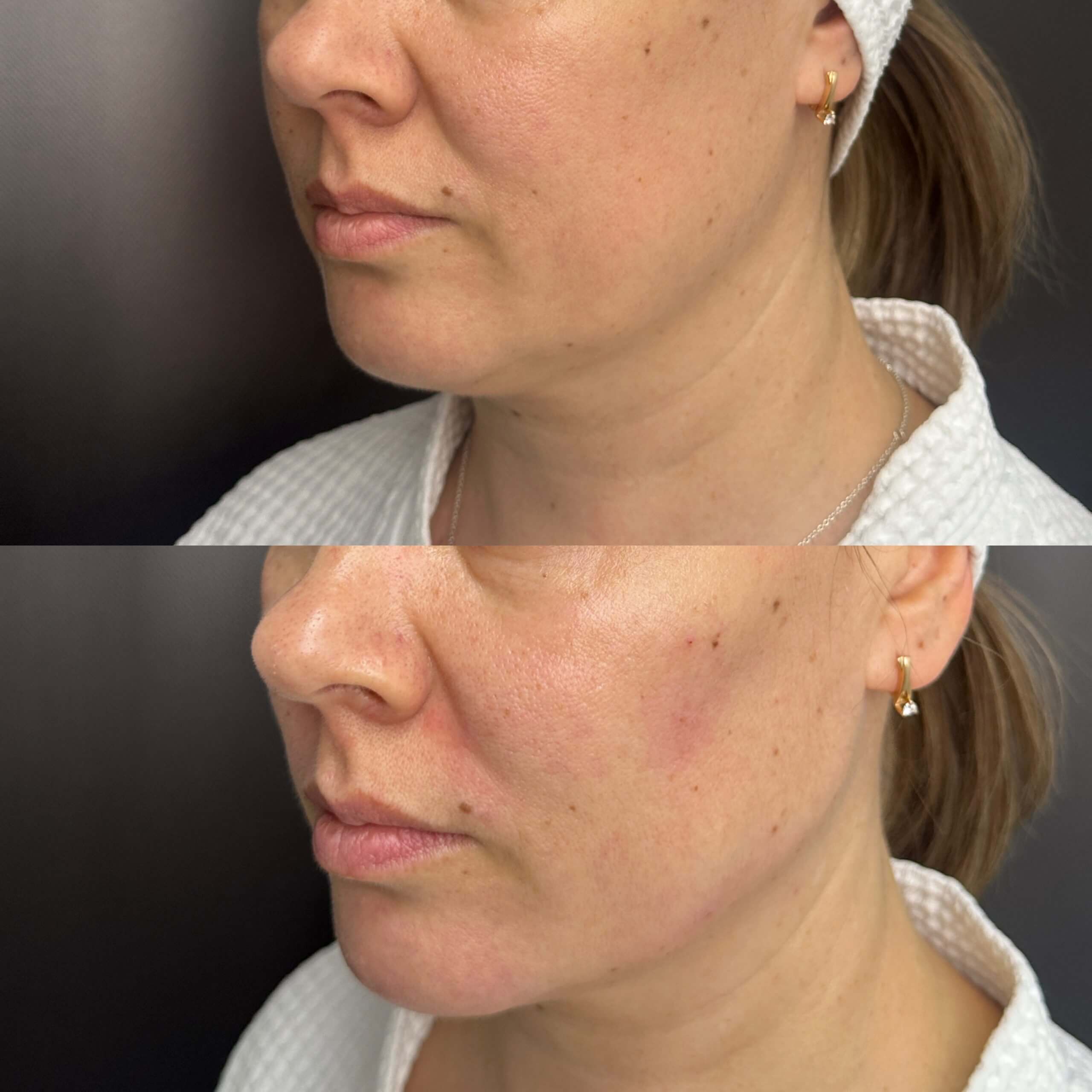 Контурная пластика лица 01