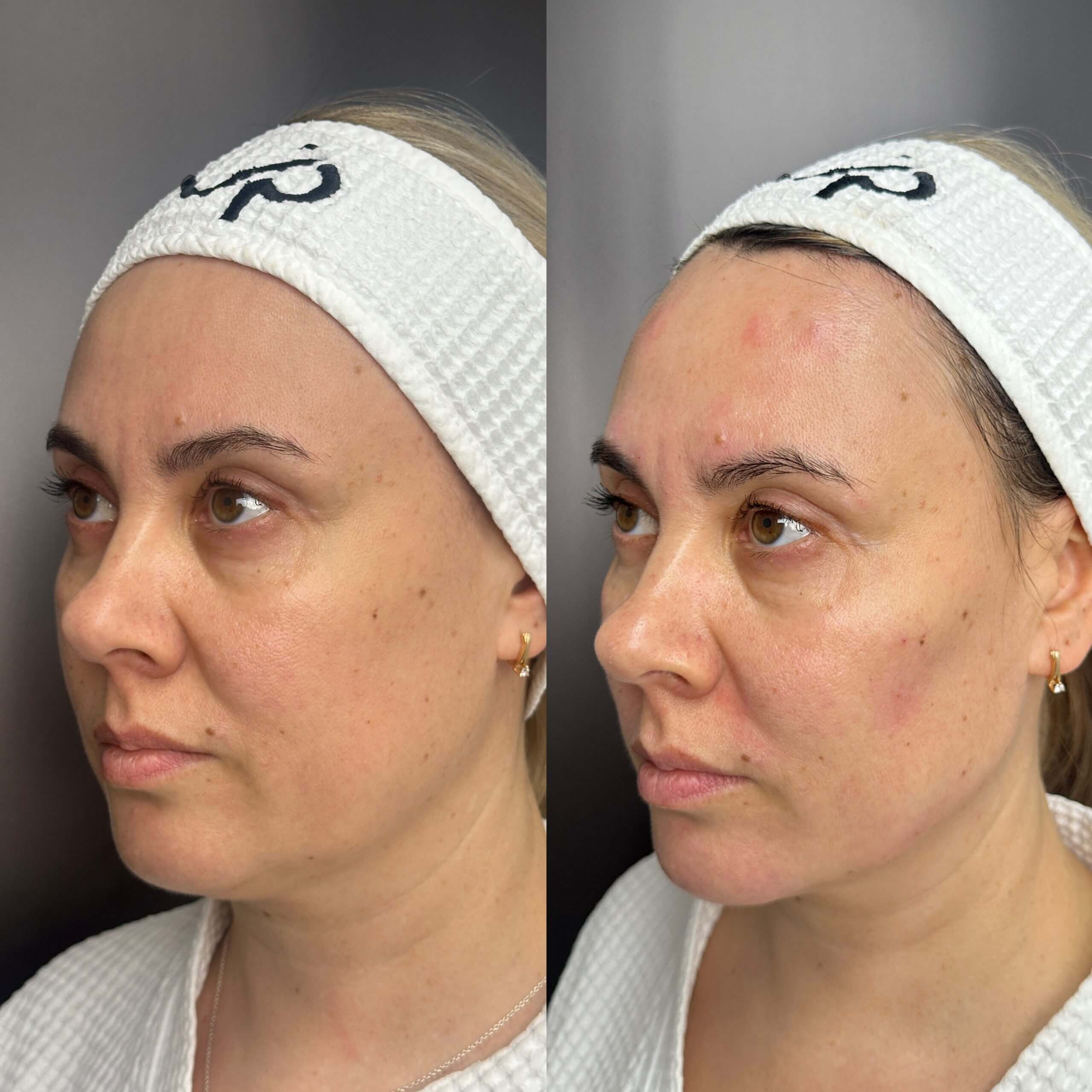 Контурная пластика лица 01