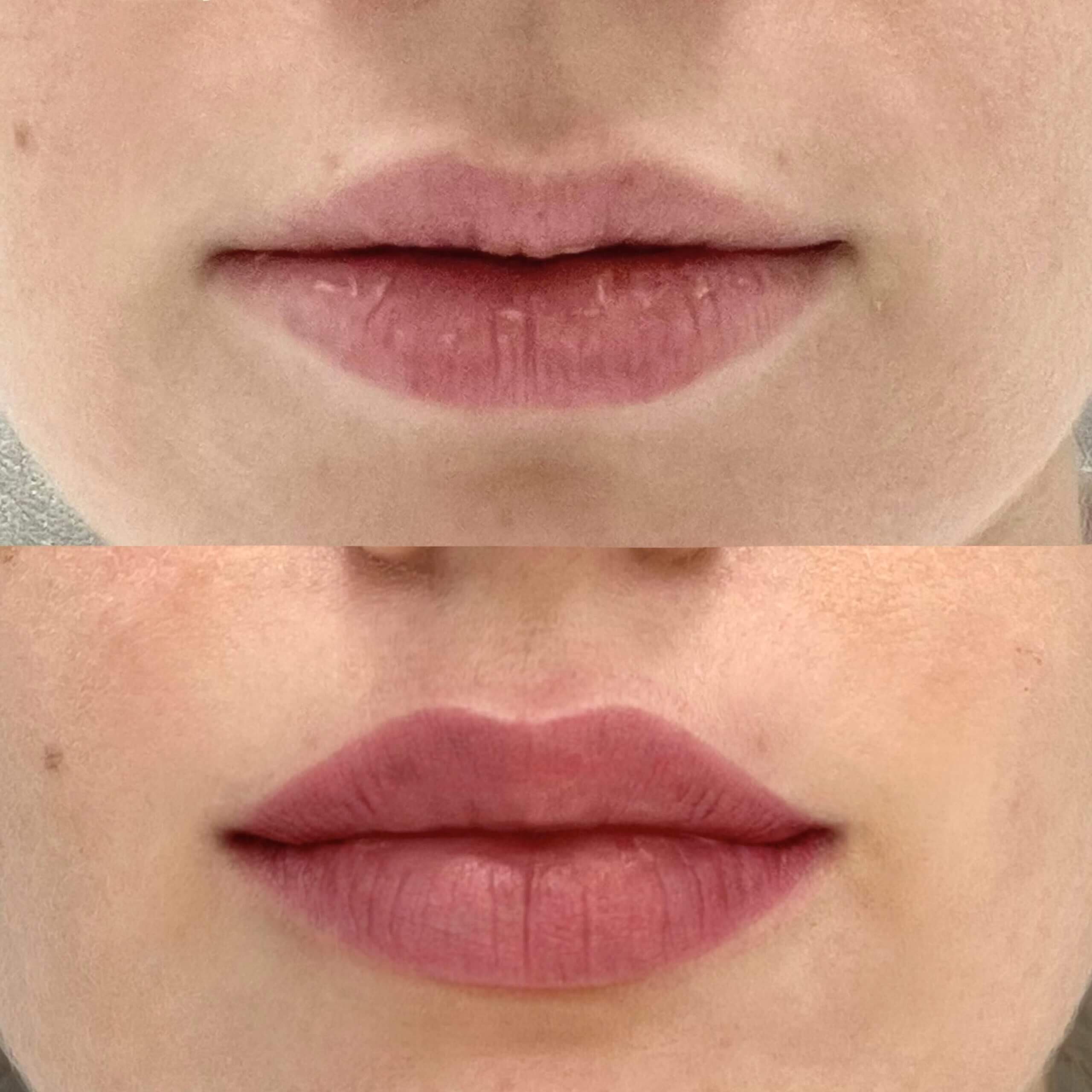 Увеличение губ 01