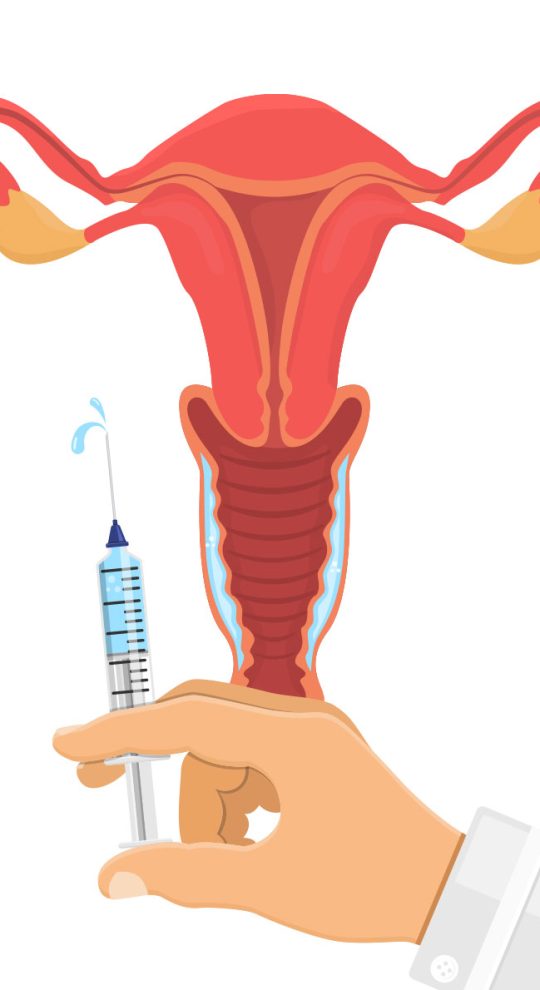 Интимное омоложение гиалуроновой кислотой