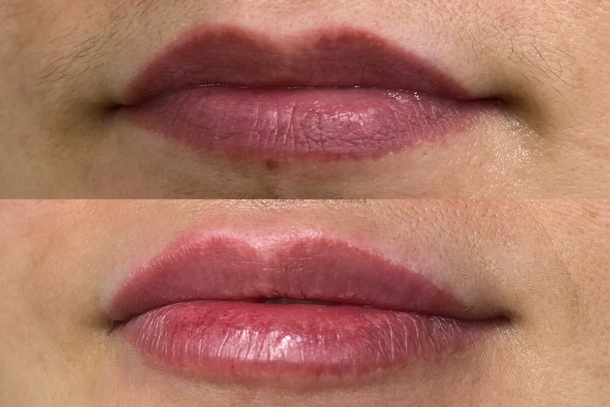 Увеличение губ 01