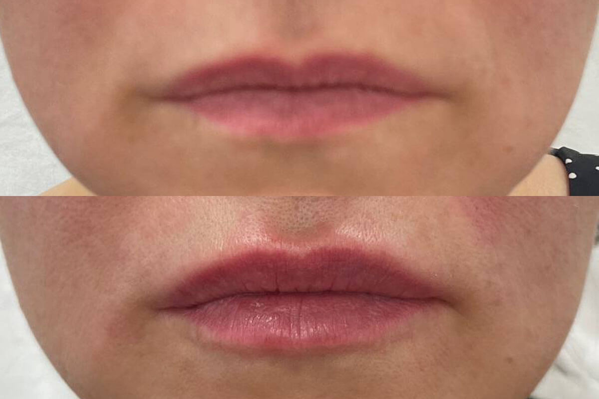 Увеличение губ 01