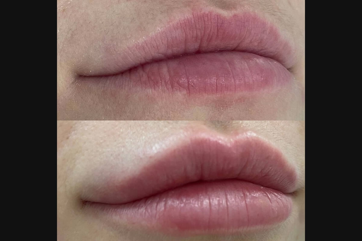 Увеличение губ 01