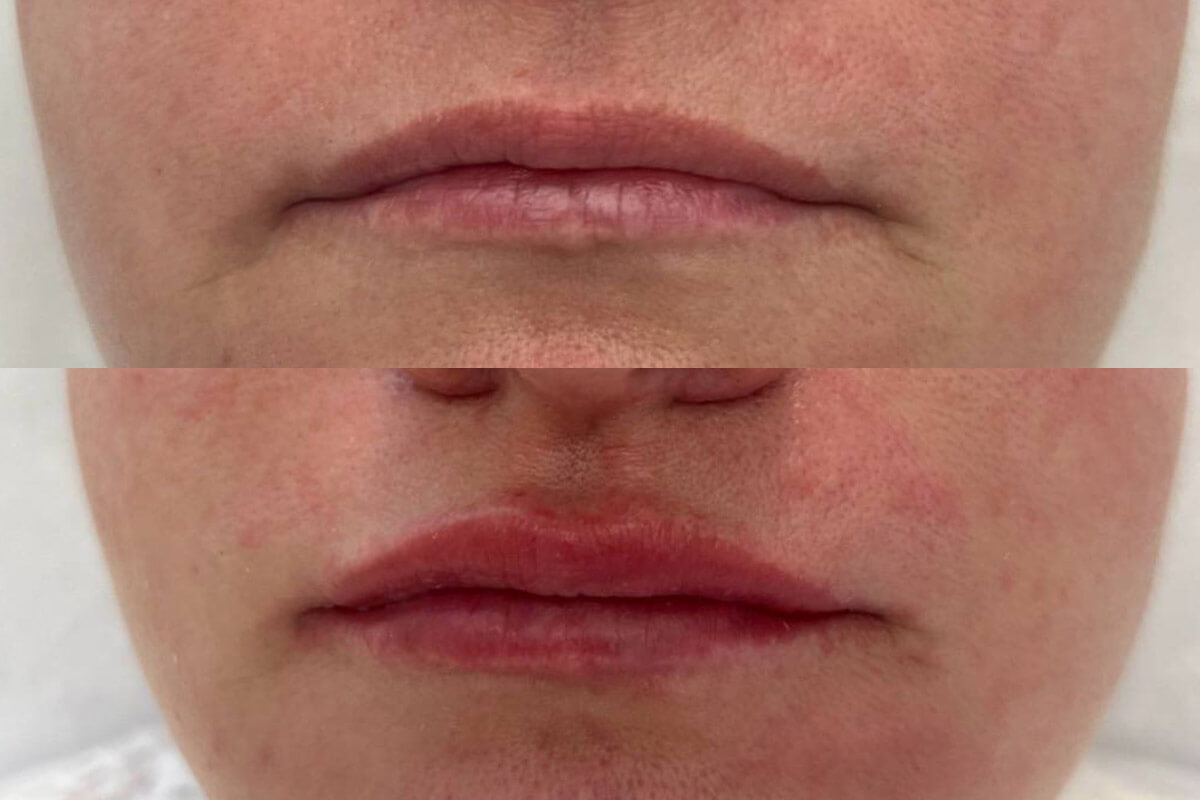 Увеличение губ 01