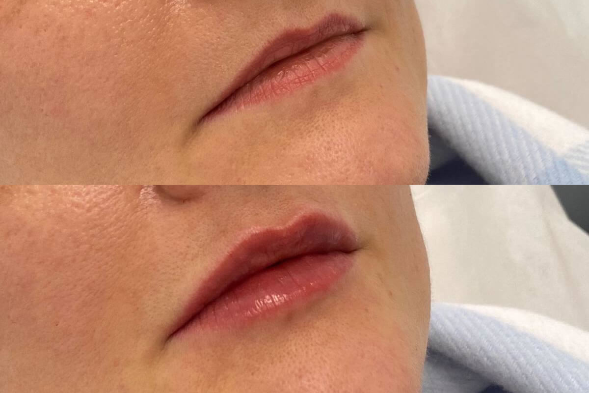 Увеличение губ 01