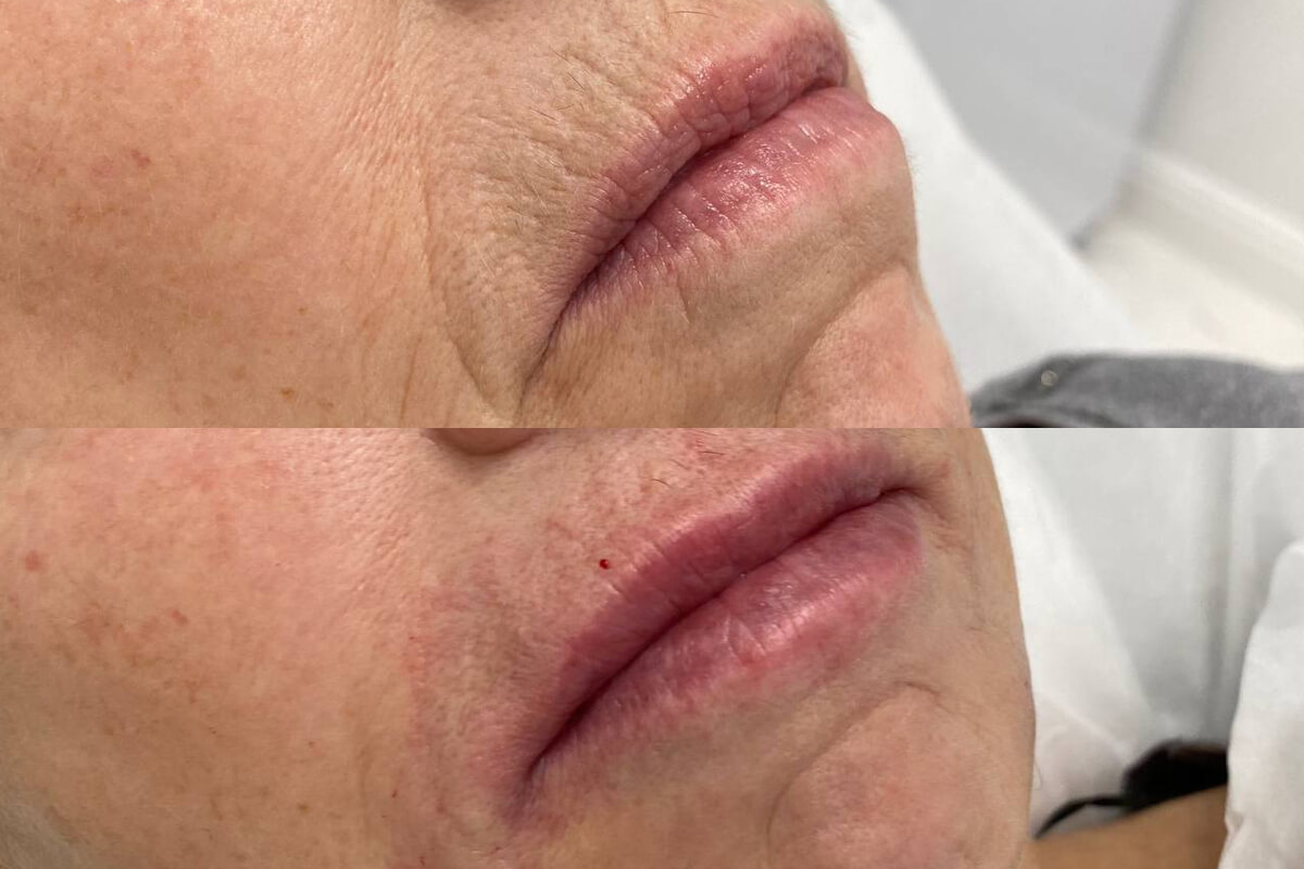 Увеличение губ 01