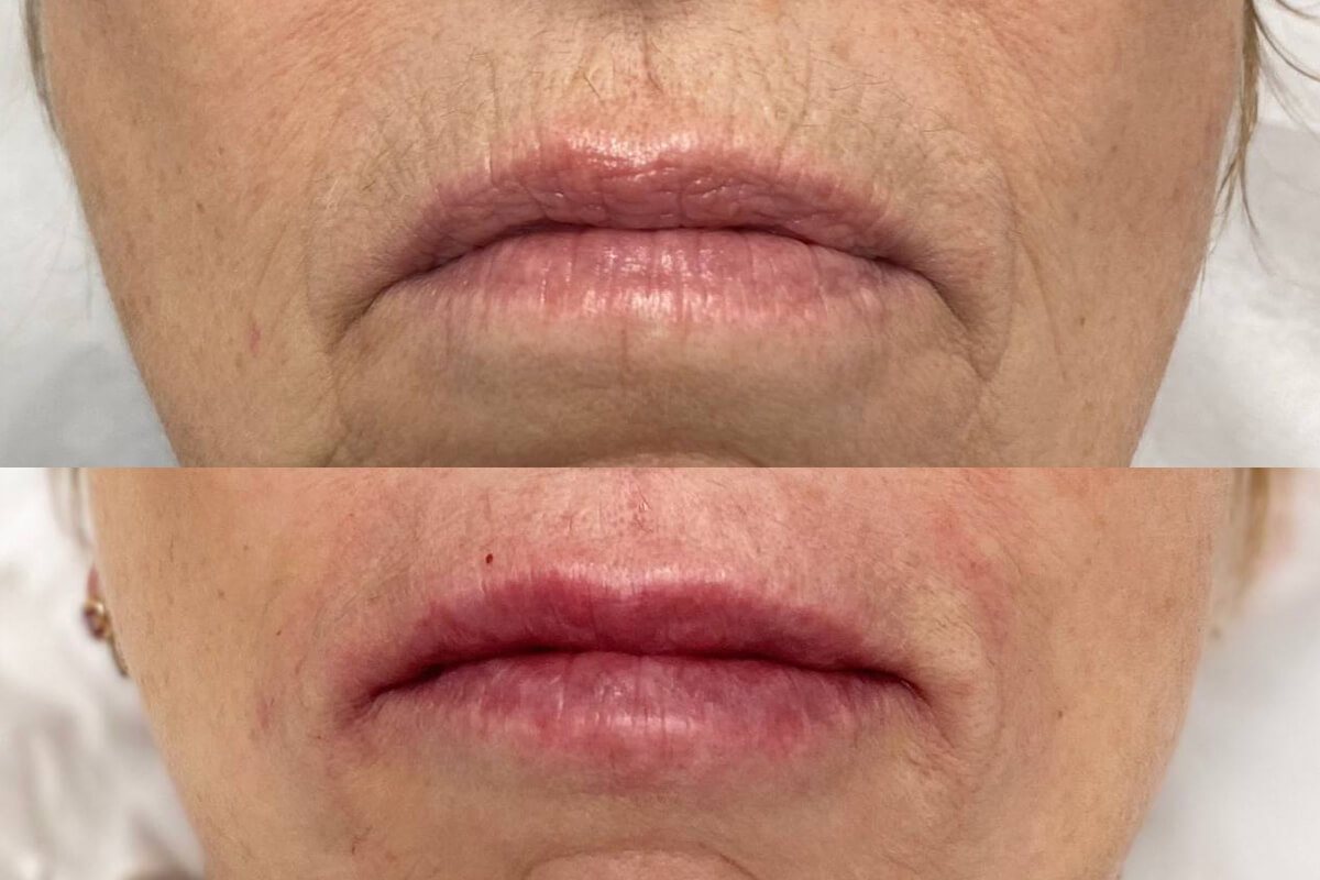 Увеличение губ 01