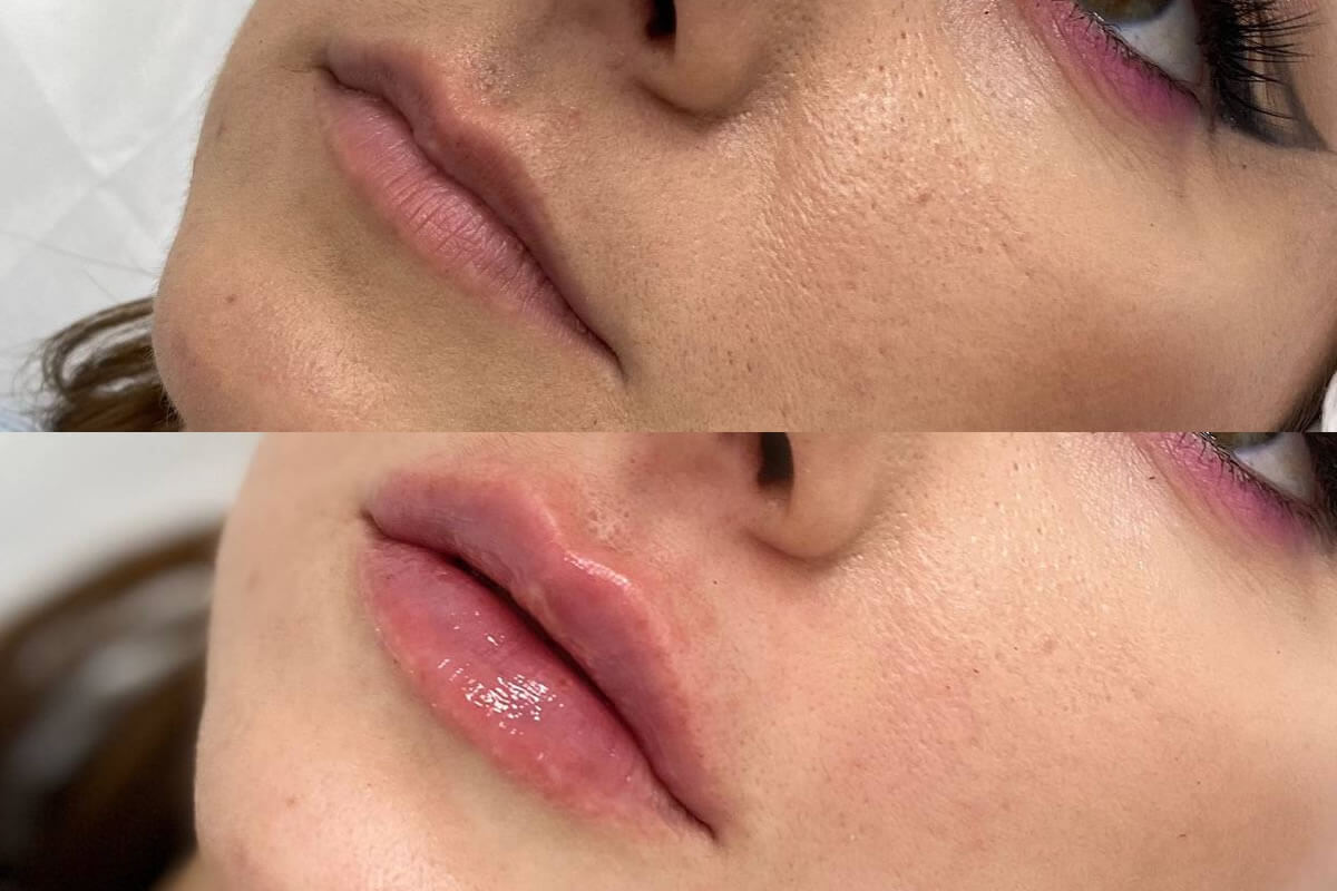 Увеличение губ 01