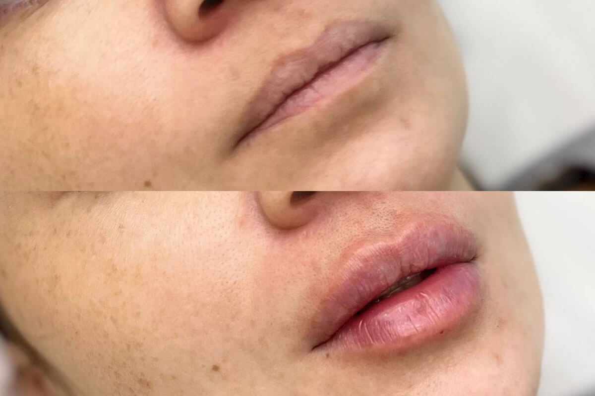 Увеличение губ 01