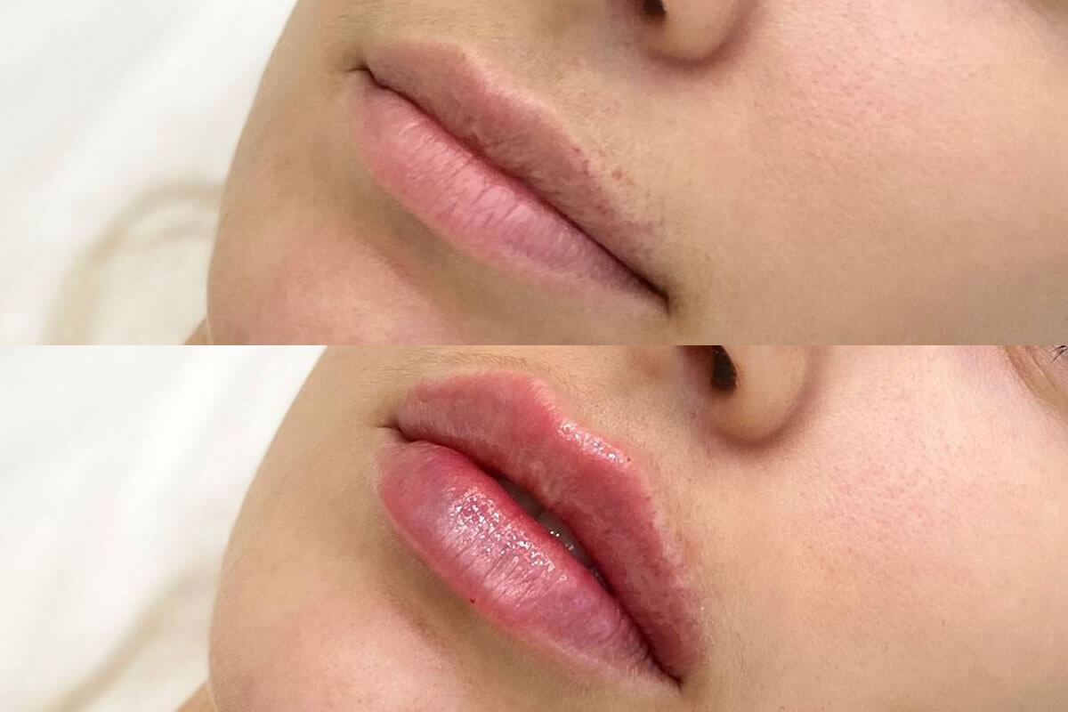 Увеличение губ 01