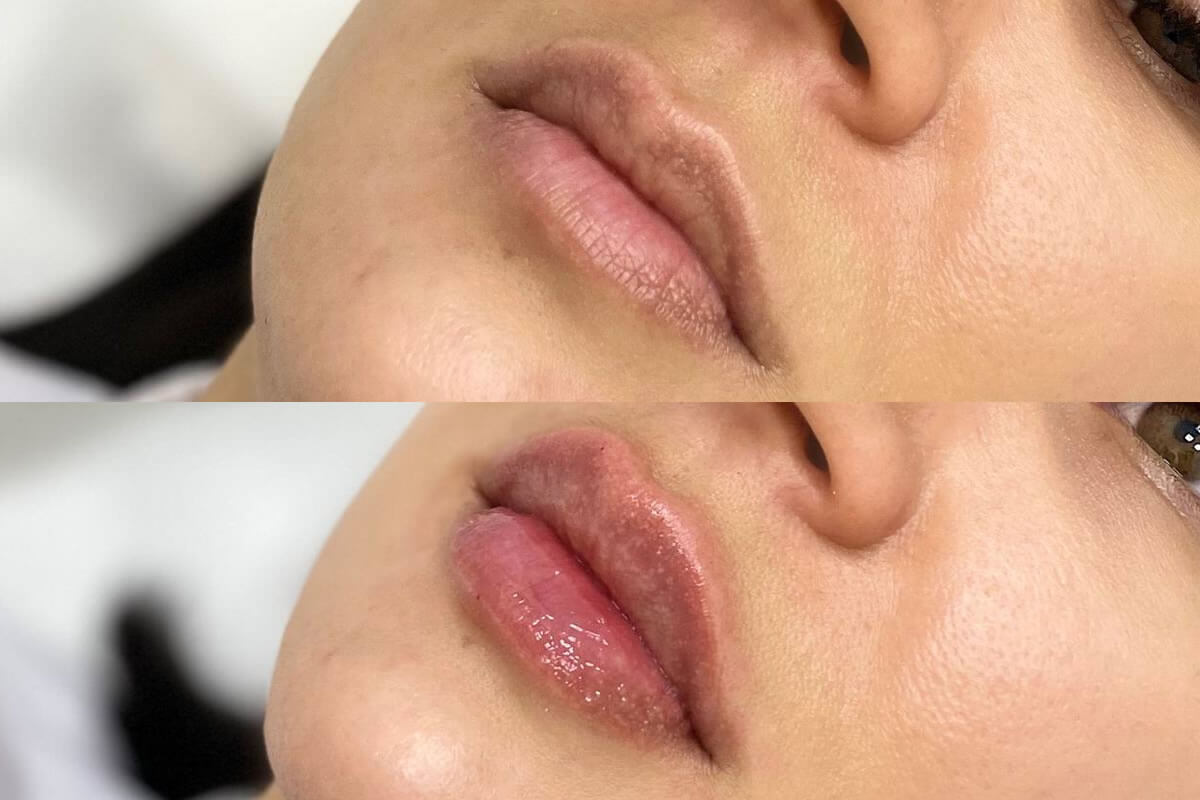 Увеличение губ 01