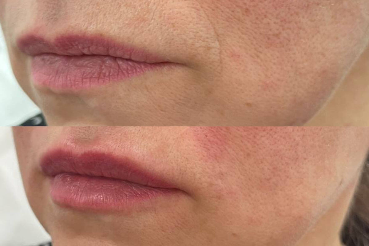 Увеличение губ 01