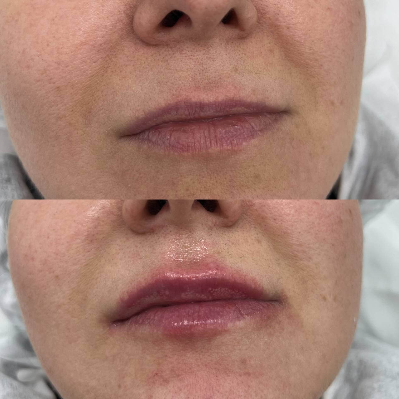 Увеличение губ 01