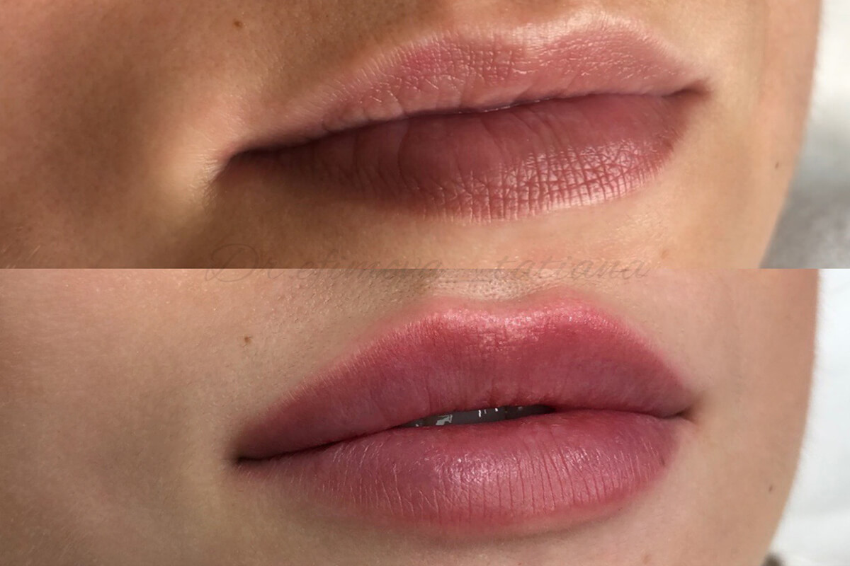 Увеличение губ 01