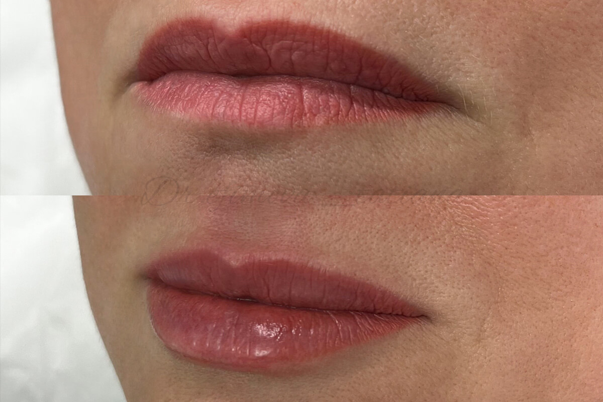 Увеличение губ 01