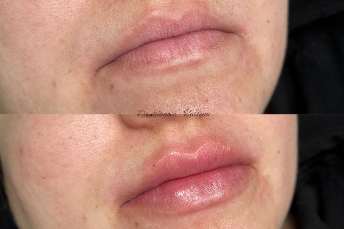 Увеличение губ 01