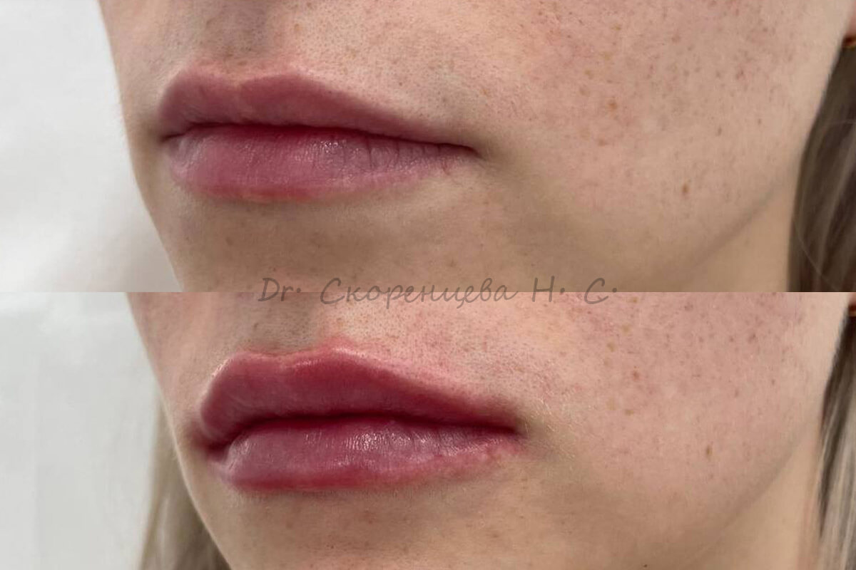 Увеличение губ 01