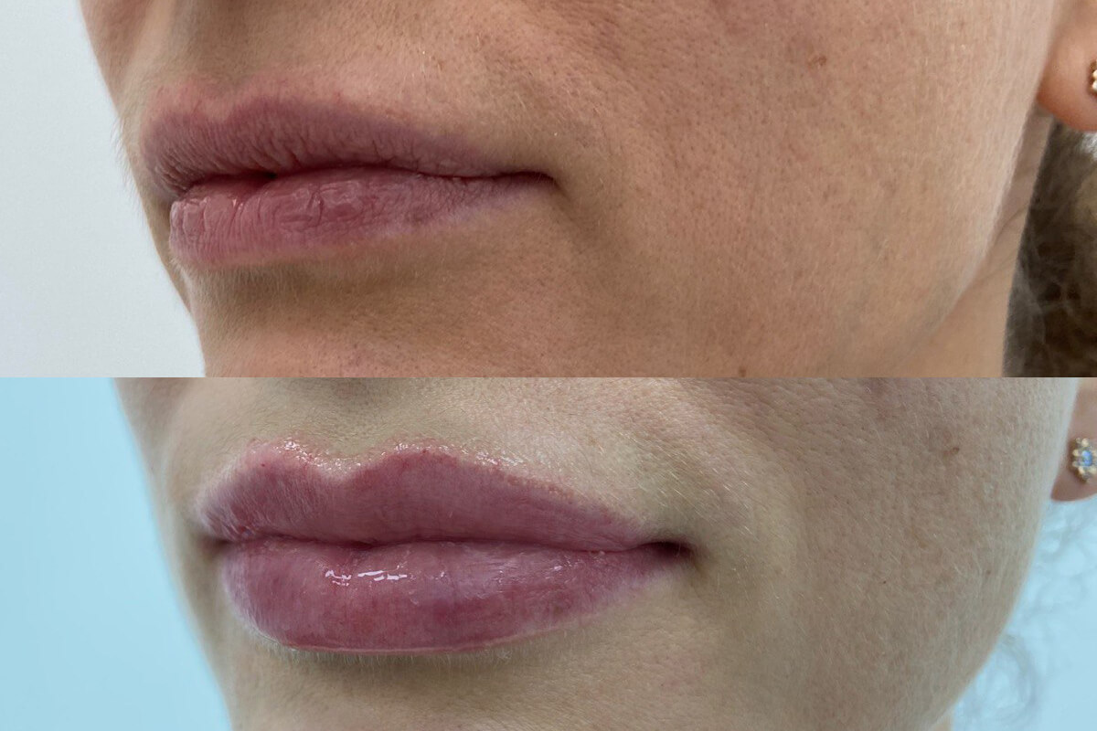 Увеличение губ 01