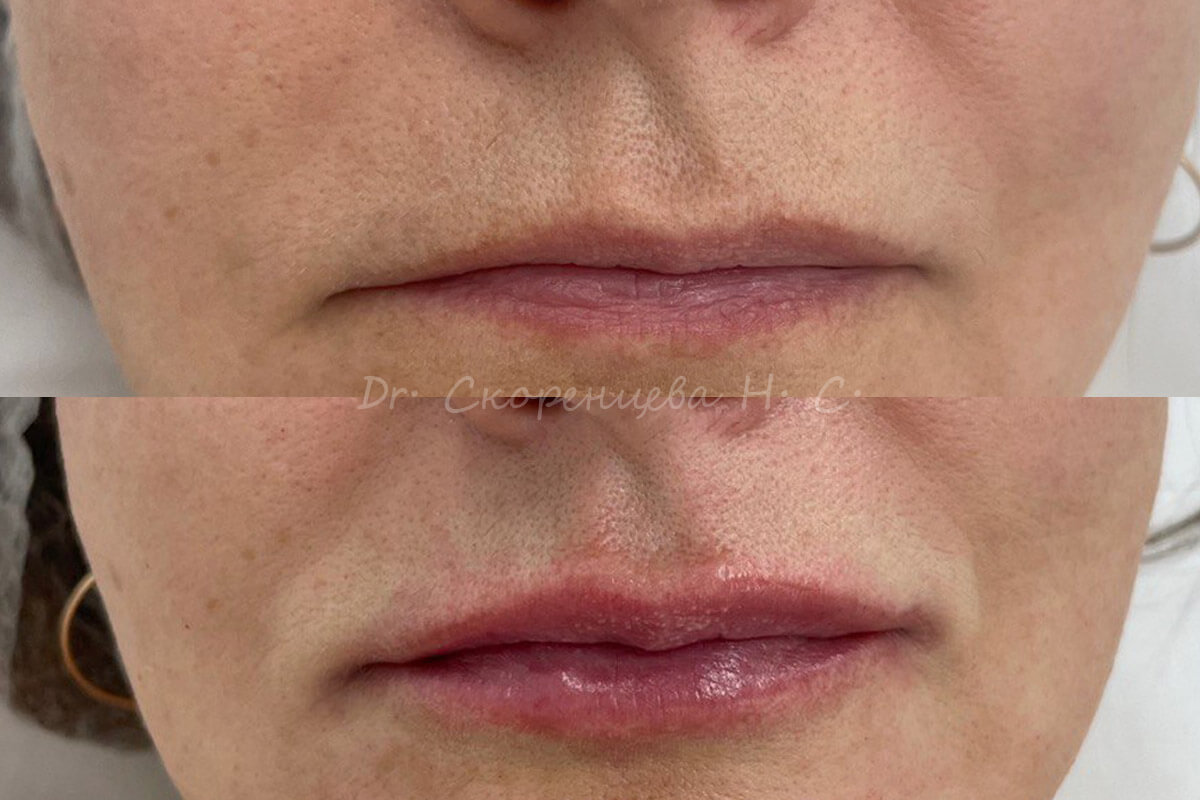 Увеличение губ 01