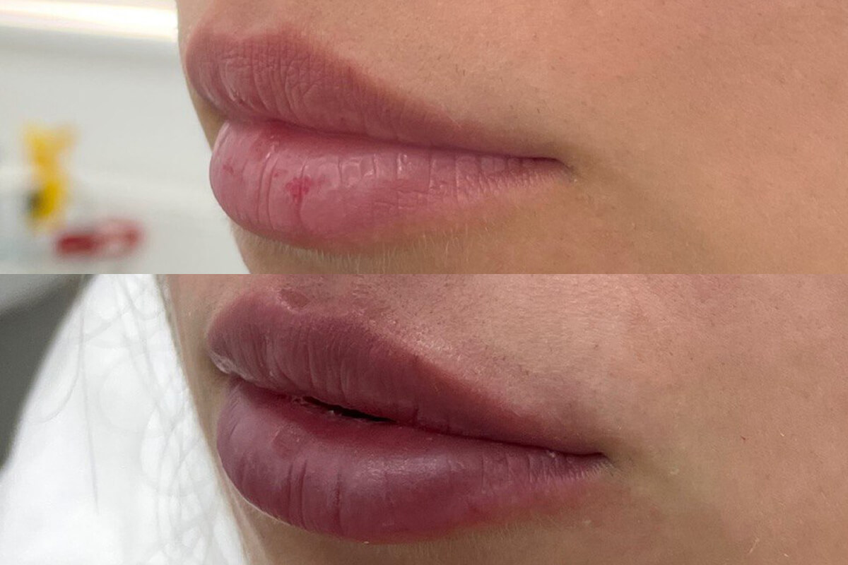 Увеличение губ 01