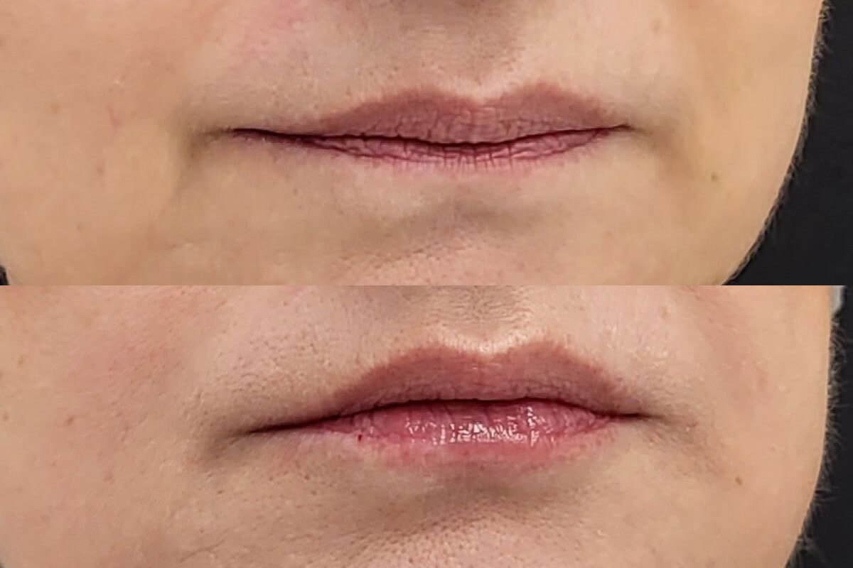 Увеличение губ 01