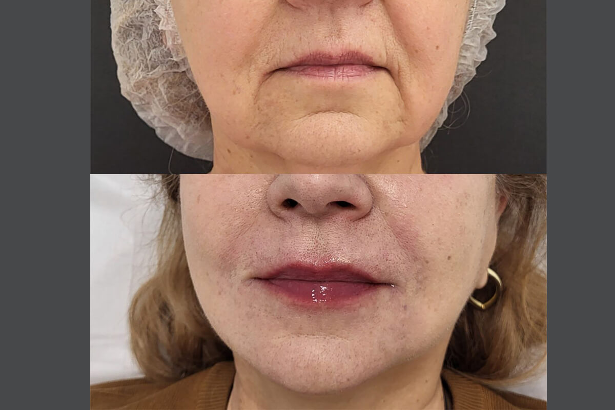 Ботулинотерапия 01