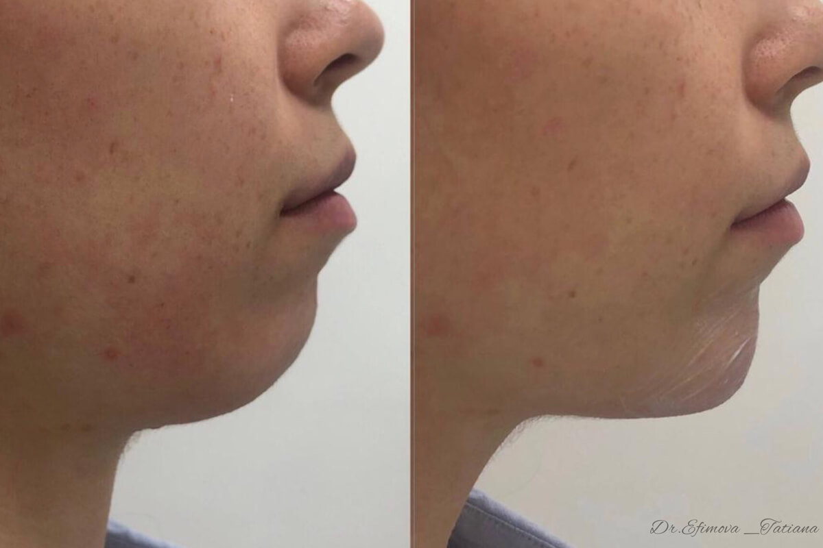 Контурная пластика лица 01