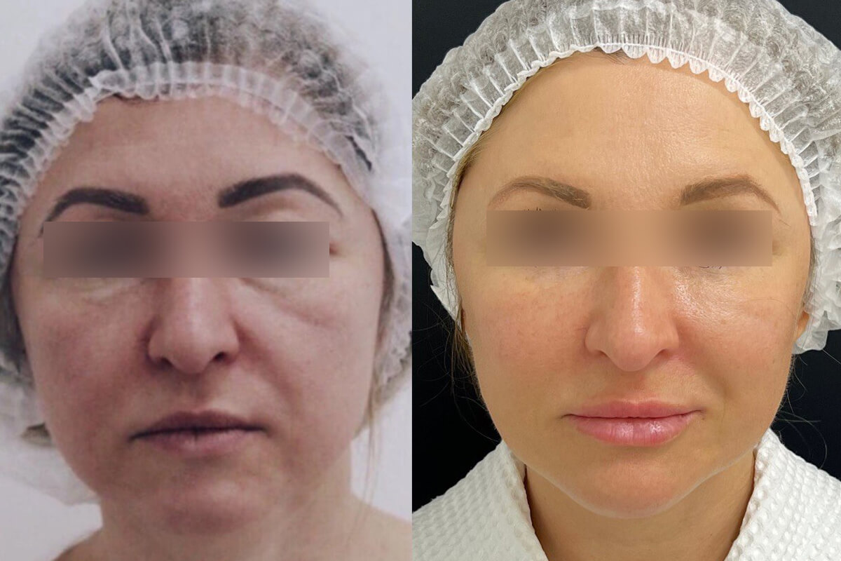 Контурная пластика лица 01