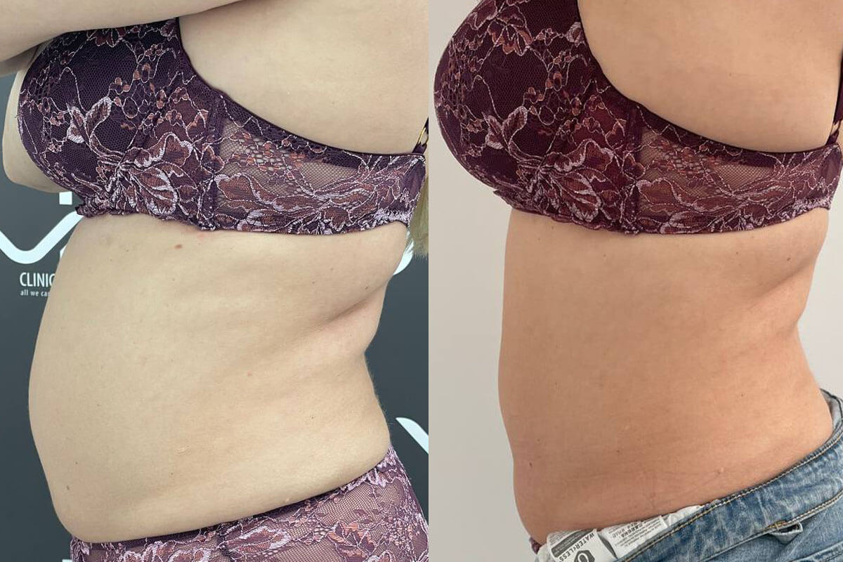 Криолиполиз Zeltiq 01