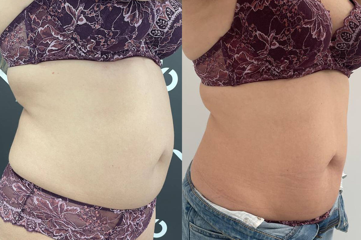 Криолиполиз Zeltiq 01