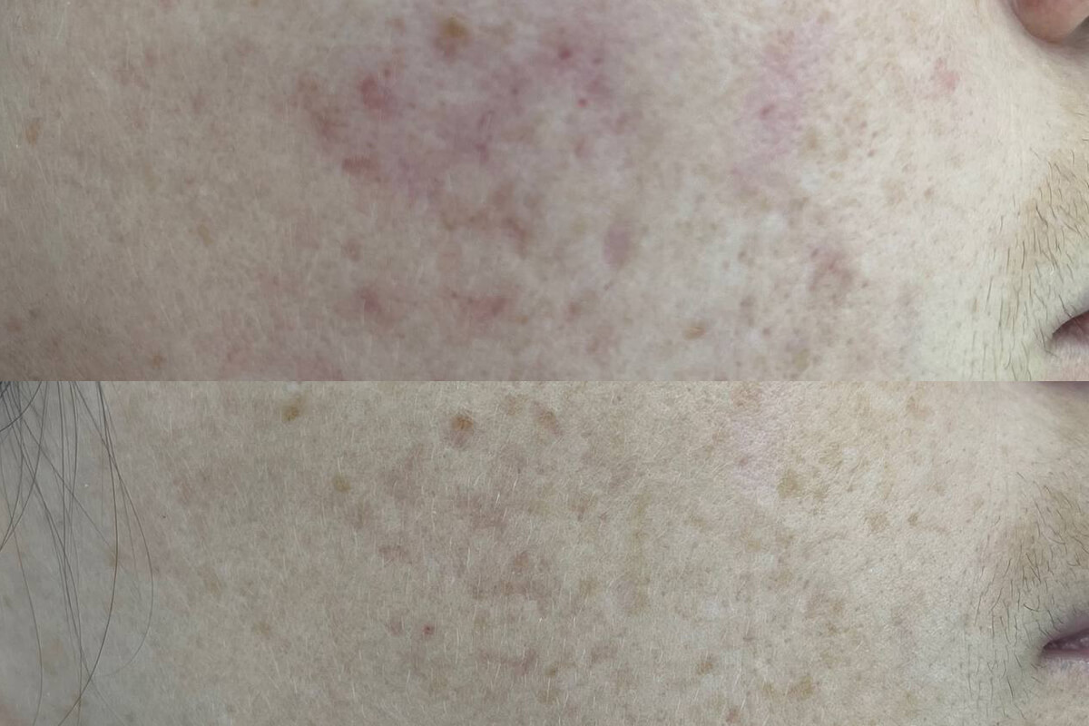 Фотоомоложение М22 01