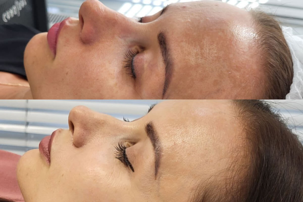 Удаление пигментации PicoSure 01