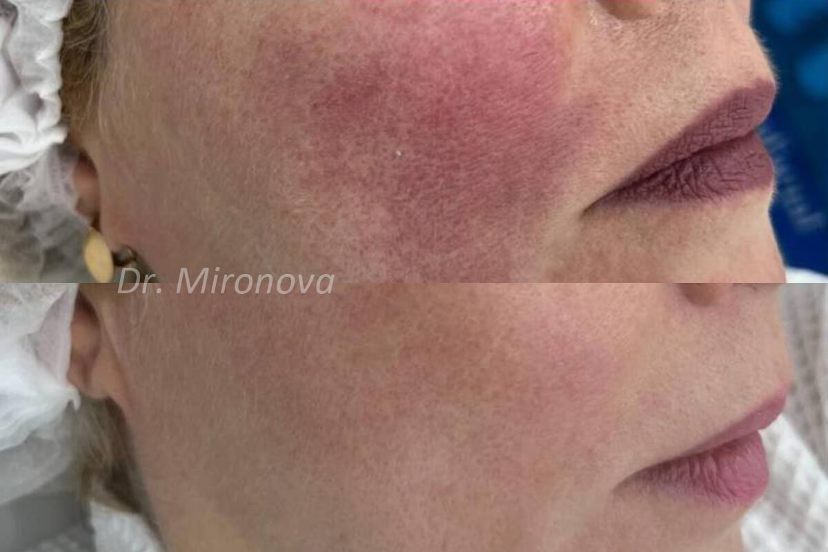 Фотодинамическая терапия Heleo-4 01