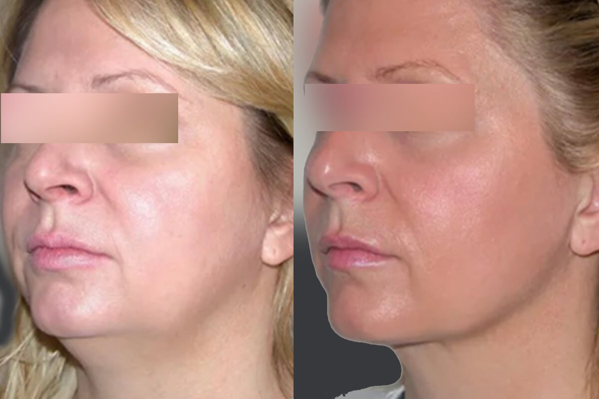 Микроигольчатый RF-лифтинг Morpheus 8 01