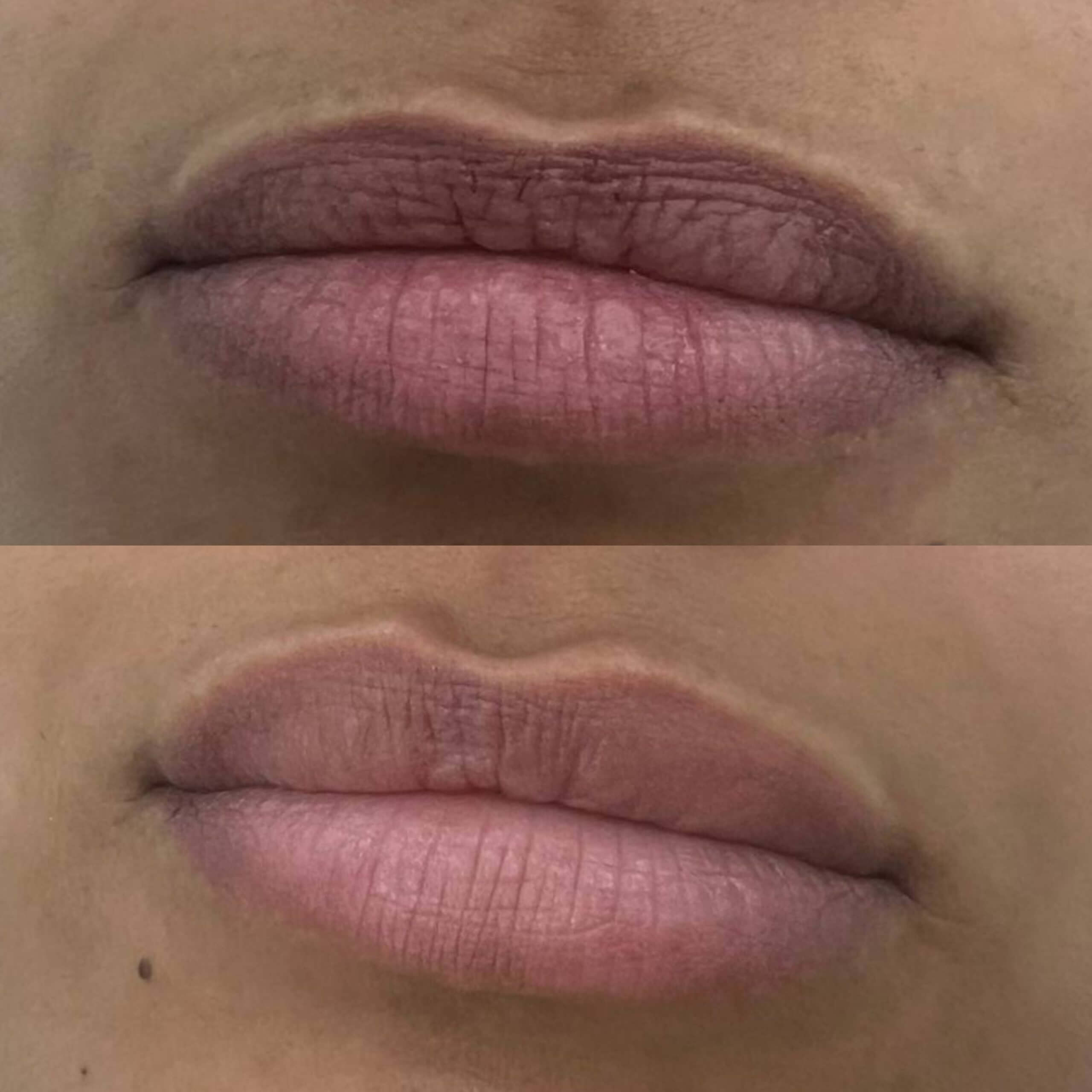 Увеличение губ 01