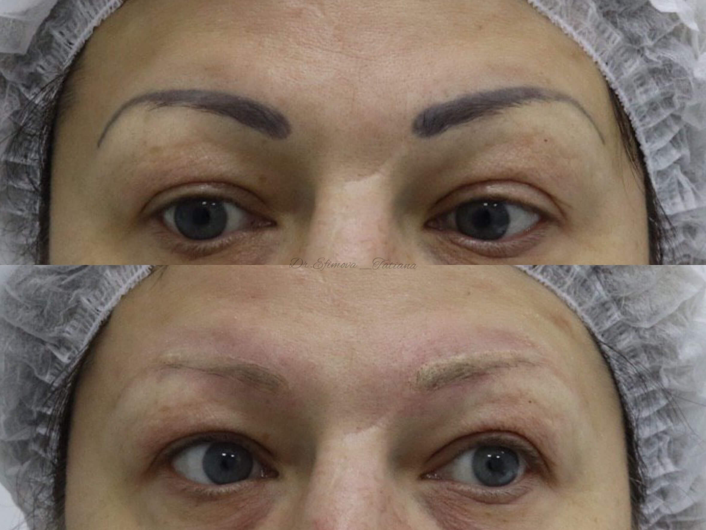 Удаление татуажа PicoSure 01